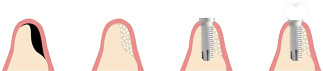 骨が少ない／薄い方